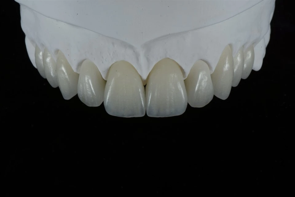رنگ برنگے دانتوں کے لیے Feldspathic Veneers