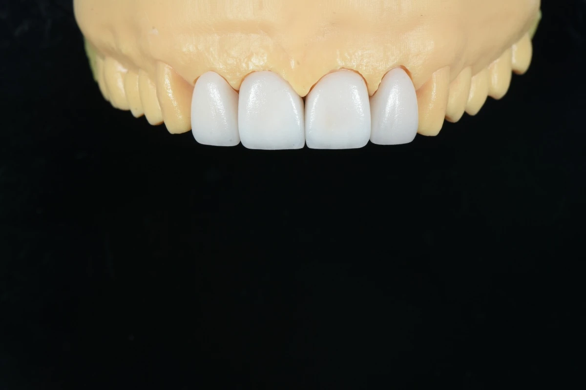 Four-Unit Maxillary Anterior E.max Veneers Four-Unit Maxillary Anterior E.max Veneers