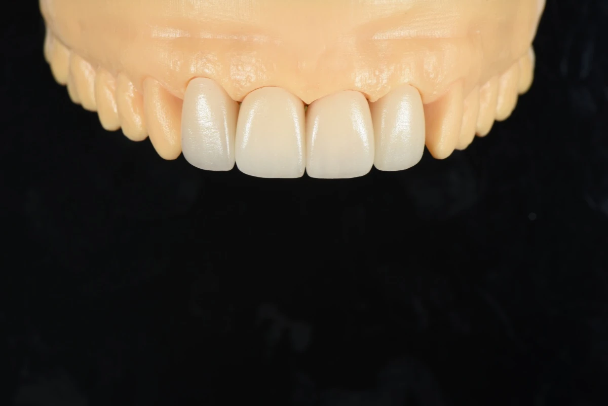 Four-Unit E.max Layering Veneers Four-Unit E.max Layering Veneers