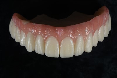 Acrylic رال عارضی تاج